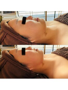 ルーク(Luke)/ハーブピーリング1回目