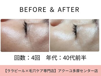 ア クーユ 多摩センター店/ララピール/しわ改善/ハリ肌