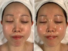 デディア 恵比寿(dedia)/PDRNリジュランマイクロニードル