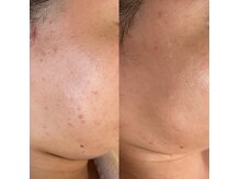 肌質改善に強い大人ニキビとシミに特化したサロン