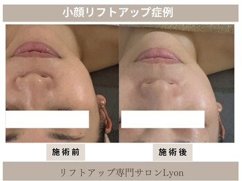 リヨン(Lyon)/（40代）小顔・リフトアップ症例