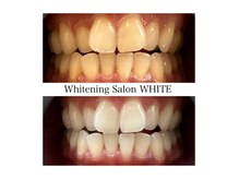 ホワイトニングサロン ホワイト 天童店(WHITE)の雰囲気（数回でこの白さに！初めての方大歓迎！！）