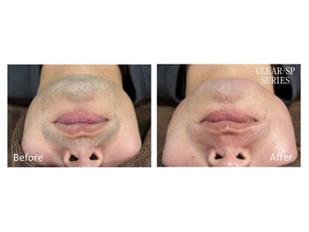 スタンド(STAND)/髭脱毛