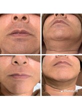 チャット(CHAT)/ひげ脱毛　経過写真