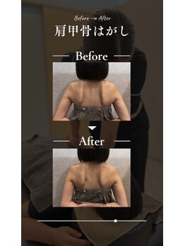 田中整骨鍼灸院 福岡白金院/肩甲骨はがし