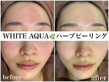 ホワイトアクア 梅田本店(WHITE AQUA)/ハーブピーリングで赤ら顔も改善