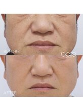 マリーローランメンズグレース(Marryrolan MensGrace)/金の糸美容術症例