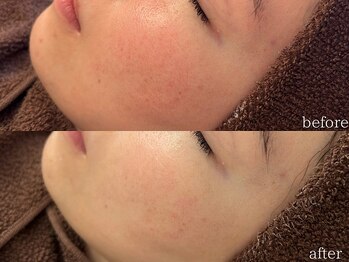 ベル(BELLE)/肌質改善お任せください♪