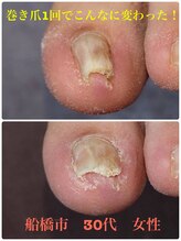 巻き爪じゅん 千葉駅前店/巻き爪早くに来ればよかった！