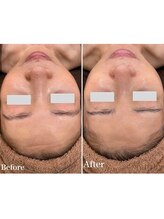 エノアビューティー(ENOA beauty)/毛穴開き解消で引き締まった肌へ