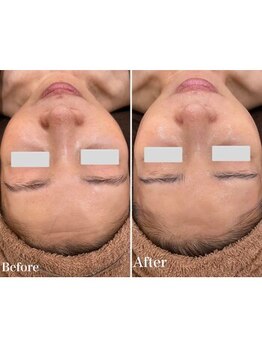 エノアビューティー(ENOA beauty)/毛穴開き解消で引き締まった肌へ