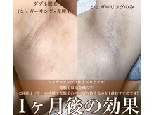 ブルーム 池袋西口店(Bloom)/脇シュガーリング＋光脱毛