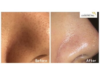 アキュレ(Acure)/ハイドロビーナス