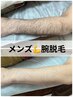 【男性限定】ウデ脱毛初回お試し♪13200→6600