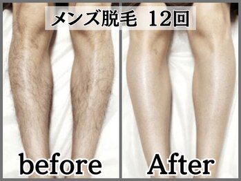 イデアルボーテ/メンズ全身脱毛メニューあります