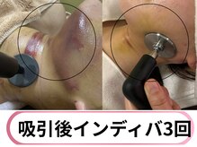 パルテール/インディバ講師による施術力