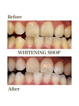 ホワイトニングショップ 安城店/【BeforeAfter】