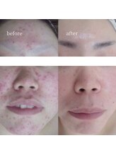 アーネスト 大阪心斎橋店(EARNEST)/肌質改善 【 慢性的なニキビ 】