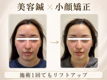 リノ ショウナン(LINO SHONAN)/美容鍼×小顔矯正