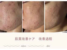 エステティックサロン シーズ/敏感なお肌でも安心してください