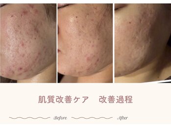 エステティックサロン シーズ/敏感なお肌でも安心してください