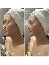 ビードット バイ ソーフライ(B.by So fly)/一度で理想の小顔に！