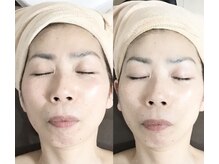 メディカルサロン かとれあ/リセラC導入とリフトアップ