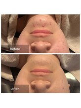 ルーチェ(Luce)/ハーブピーリング