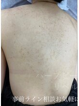 リベル 名古屋(Lebelle:)/ハーブピーリング専門名古屋