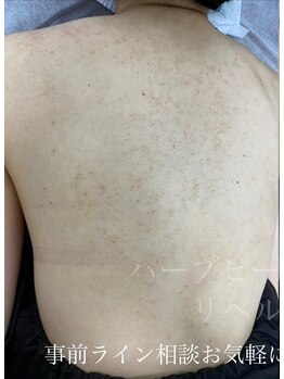 リベル 名古屋(Lebelle:)/ハーブピーリング専門名古屋