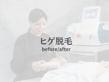 ボス 桑名店(BOSS)/ヒゲ脱毛【before after】#脱毛