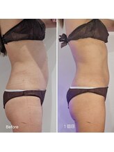 ラクト サロン(RAKT salon)/脂肪冷却４カップ 脇腹 上下腹部