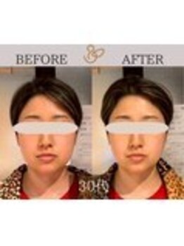 チョコバリ 錦糸町店(chocobari)/小顔×リフトアップ(美容鍼)30代