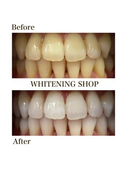 ホワイトニングショップ 安城店/【BeforeAfter】