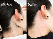 ピミル(PIMIL)/うなじ脱毛