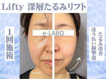イーラボ 池袋店(e-LABO)/たるみケア/ほうれい線ケアに!