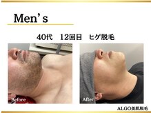 アルゴ 堺東駅前店(ALGO)の雰囲気（【メンズ脱毛】ワックス脱毛+光脱毛で即日効果実感。）