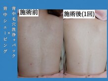 シェリー(Cheri)/背シェ+背毛穴洗浄+パック