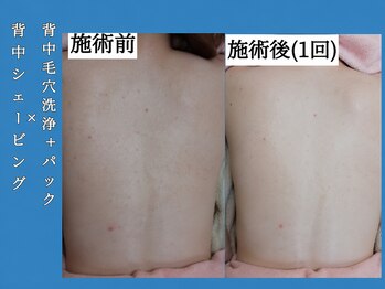 シェリー(Cheri)/背シェ+背毛穴洗浄+パック