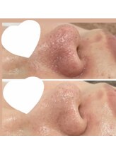 カルディエ(Cardie)/肌質改善　ビフォーアフター