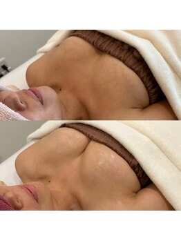 マイントゥー(mine too)/バストアップ症例