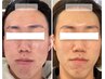 【メンズハーブ】ガッツリ肌質改善！剥離ハーブピーリングでニキビケア◎