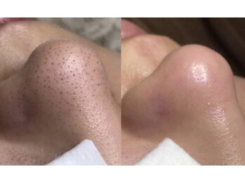 フローレント(Florent)/毛穴洗浄ハイドロフェイシャル