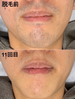 ツボミ(TSUBOMI)/メンズヒゲ脱毛