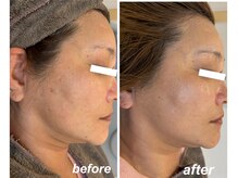 マイルーチェ 可児川合店(MyLuce)/人気のマシン！　光糸リフト