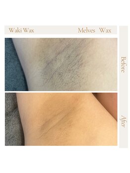 メルベスワックス(MELVES WAX)/脇ダブル脱毛