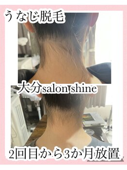サロンシャイン(Salon Shine)/うなじ脱毛経過