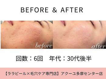 ア クーユ 多摩センター店/ララピール/毛穴/ニキビケア美肌