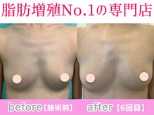 サラエクセレント 心斎橋(SARA EXCELLENT)/内側に脂肪が付いてきています♪