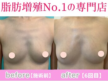 サラエクセレント 心斎橋(SARA EXCELLENT)/内側に脂肪が付いてきています♪